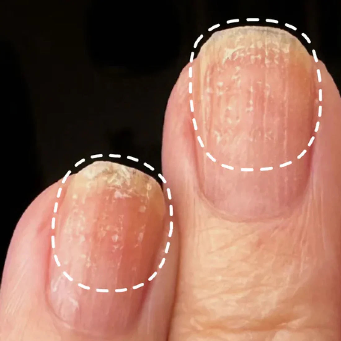 Close-up of two fingernails with rough, white, and flaky surfaces, outlined with dashed white lines to highlight the affected areas. The nails appear unhealthy and possibly damaged.